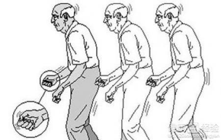 帕金森病的癥狀，深入了解與應(yīng)對，帕金森病癥狀詳解及應(yīng)對策略