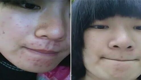 揭秘三天快速去痘印小竅門，輕松恢復肌膚光彩，三天快速去痘印秘訣大揭秘，輕松重塑肌膚光彩