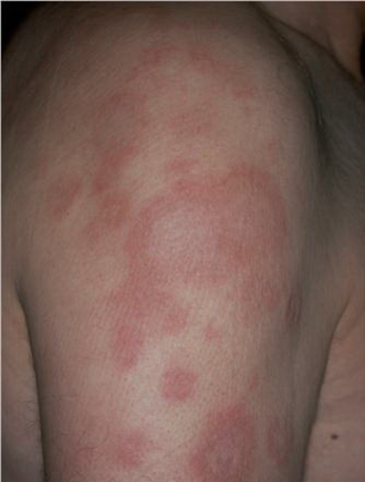 艾滋病紅斑早期圖片，了解、預防與應對，艾滋病紅斑早期圖片詳解，預防與應對策略