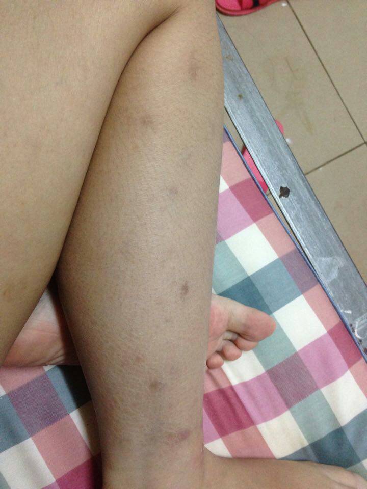 蚊子咬后留下黑疤如何去除——全面解析去除黑疤的有效方法，蚊子咬后黑疤如何去除，有效方法全面解析