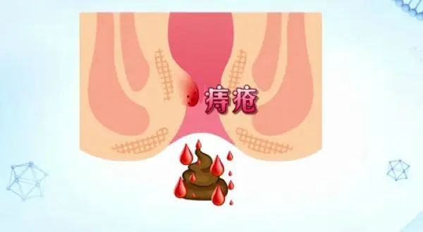 大便出血，痔瘡還是肛裂？一篇文章帶你了解，大便出血，痔瘡還是肛裂？一篇文章全面解析