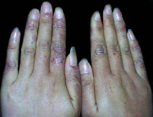 根治凍瘡，預防復發(fā)，全面解析凍瘡的治療方法，根治凍瘡，預防復發(fā)，全面解析凍瘡治療策略