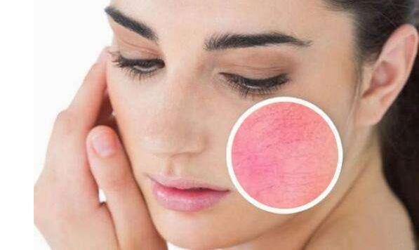 如何有效去除紅血絲，最佳方法與實用建議，紅血絲去除攻略，最佳方法與實用建議