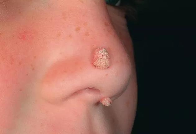 如何判斷是否為雞眼——全面解析雞眼癥狀與診斷方法，雞眼癥狀詳解，診斷方法與判斷指南