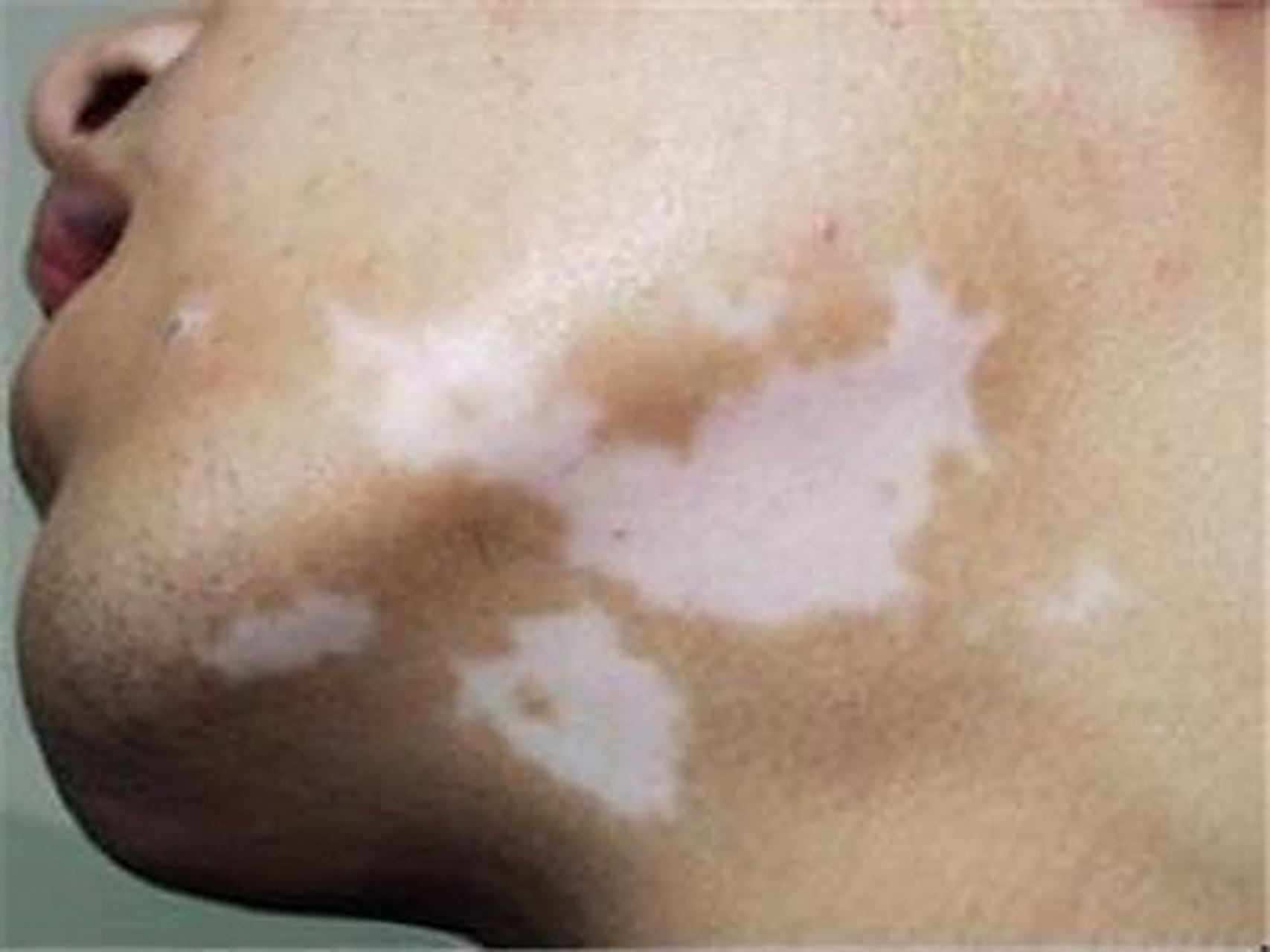 白點(diǎn)癲風(fēng)怎么治療效果最好，全面解析最佳治療方案，全面解析白點(diǎn)癲風(fēng)最佳治療方案，治療效果最大化