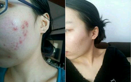 長(zhǎng)青春痘怎么處理最好？全面解析最佳應(yīng)對(duì)策略，全面解析青春痘最佳應(yīng)對(duì)策略，最佳處理方法與建議