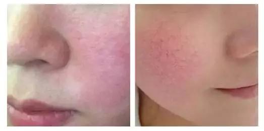 臉頰紅血絲如何修復，全面解析與實用建議，臉頰紅血絲全面解析與修復實用建議