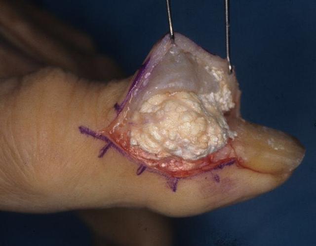 痛風(fēng)結(jié)晶溶解時(shí)間，影響因素與應(yīng)對(duì)策略，痛風(fēng)結(jié)晶溶解的時(shí)間、影響因素及應(yīng)對(duì)策略詳解