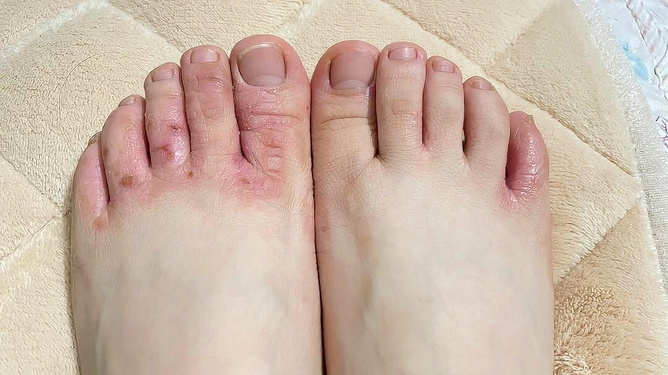 腳氣爛腳趾縫癢潰爛的治療方法，全面解析與應對策略，腳氣爛腳趾縫癢潰爛全面解析與治療策略