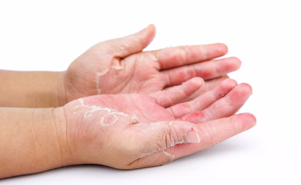 皰疹最佳治療方法，全面解析與個(gè)性化護(hù)理策略，皰疹最佳治療方法詳解，全面解析與個(gè)性化護(hù)理策略