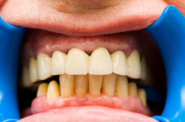 牙齦萎縮，了解、預(yù)防與治療，牙齦萎縮，全面解析了解、預(yù)防與治療的方法