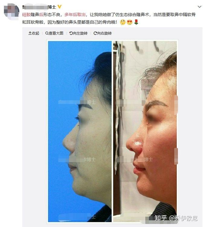 硅膠與膨體隆鼻，哪個(gè)更好？全面解析與比較，硅膠與膨體隆鼻，哪個(gè)更優(yōu)？全面解析與比較指南