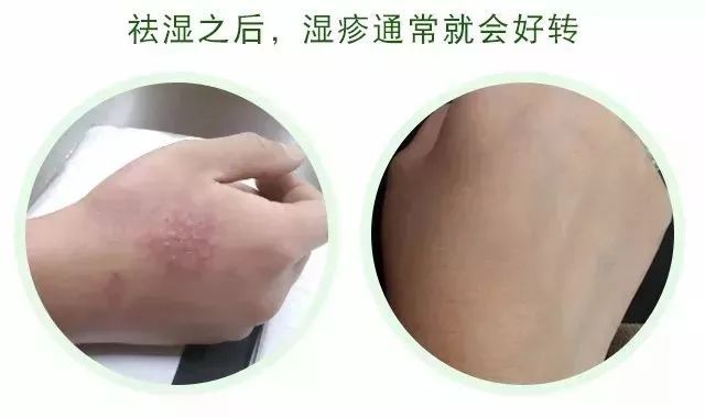 一般濕疹多久會(huì)消失，深入了解濕疹及其消失時(shí)間因素，濕疹消失時(shí)間解析，影響因素與深度了解