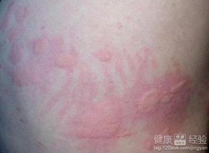 急性蕁麻疹會(huì)傳染嗎？解析蕁麻疹的真相與誤區(qū)，急性蕁麻疹是否會(huì)傳染？真相解析與誤區(qū)探討
