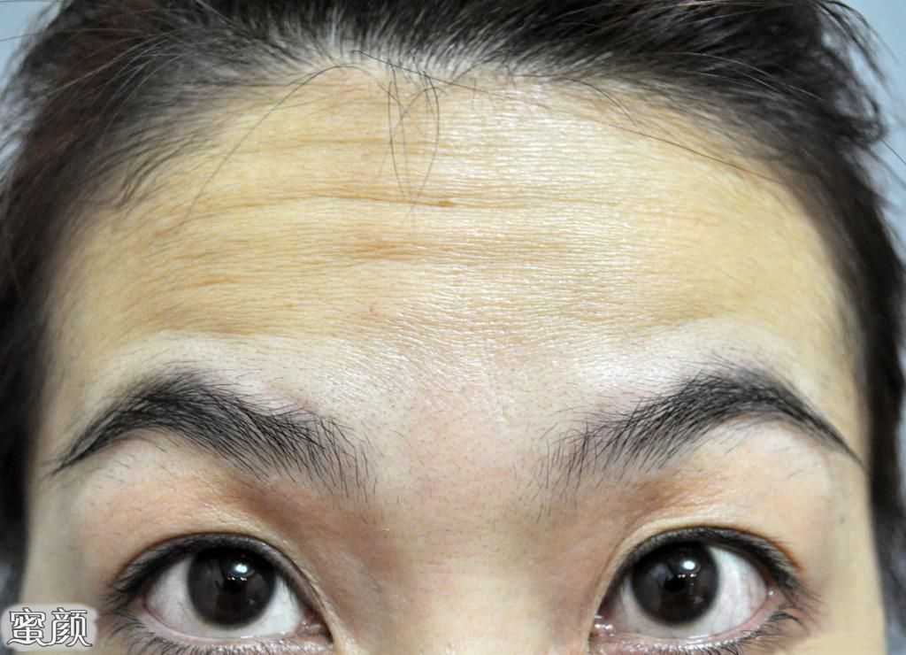 消除抬頭紋最簡(jiǎn)單方法，實(shí)用指南與技巧，消除抬頭紋的有效方法與實(shí)用指南