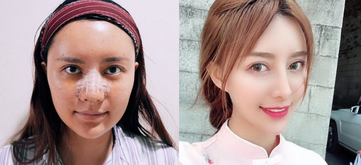 整鼻子老了之后圖片，深度探討鼻子整形手術(shù)的長遠(yuǎn)影響與變化，深度探討，鼻子整形手術(shù)的長遠(yuǎn)影響與變化——鼻子老化后的圖片解析